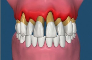 priodoncia