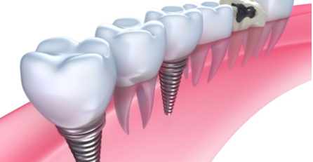 implantes