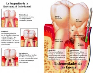 tratamiento-periodoncia